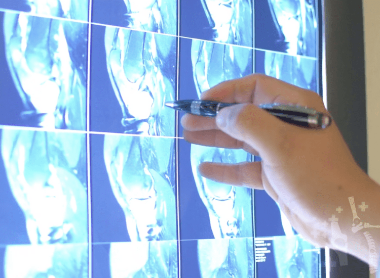 Traumatologos especialistas en tumores oseos Queretaro